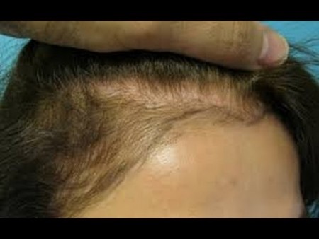Minoxidil sur femme