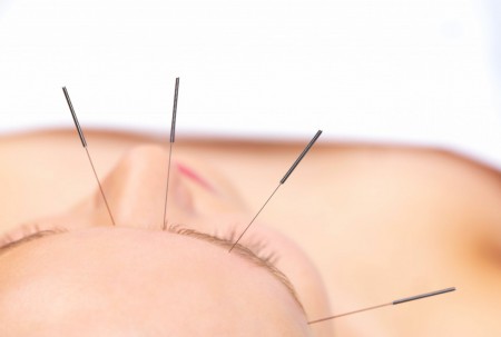 séance acupuncture esthétique