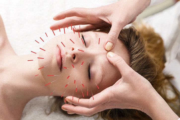 Les effets liftant de l'acupuncture pour une peau lisse rajeunie