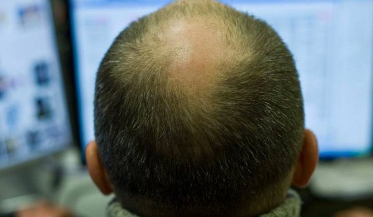 Minoxidil 5, efficace contre la perte de cheveux