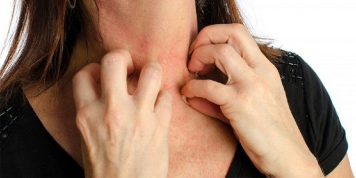 Zoom sur l'urticaire solaire : l'allergie au soleil et les solutions