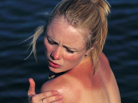 Les causes et le diagnostic de l'urticaire solaire